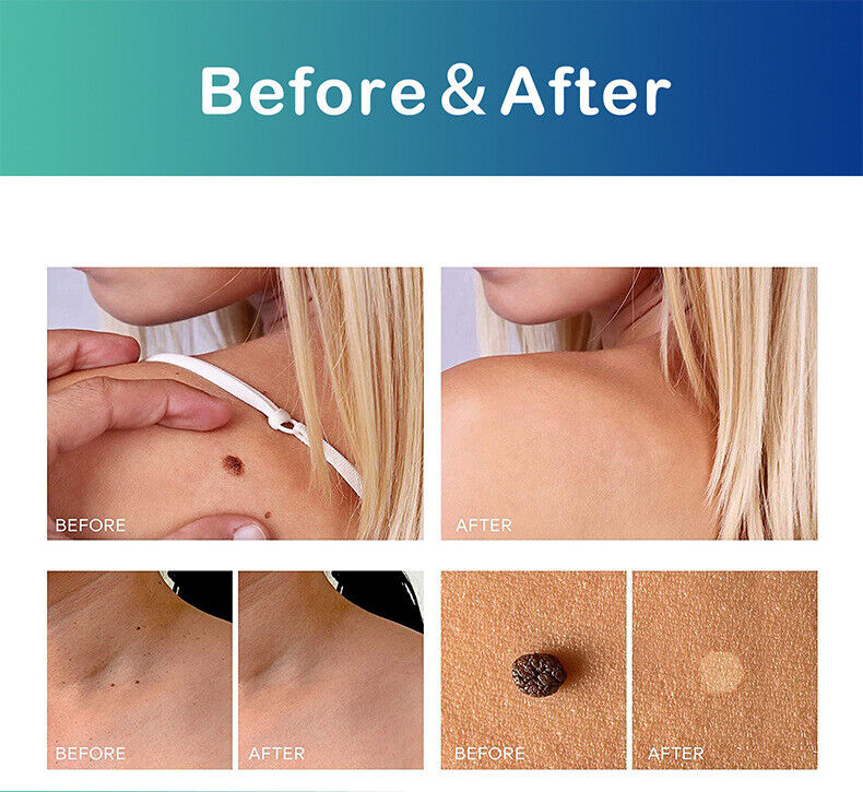 Skin Tag After-Before